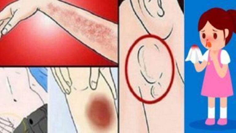 Você conhece os sinais e sintomas da leucemia?