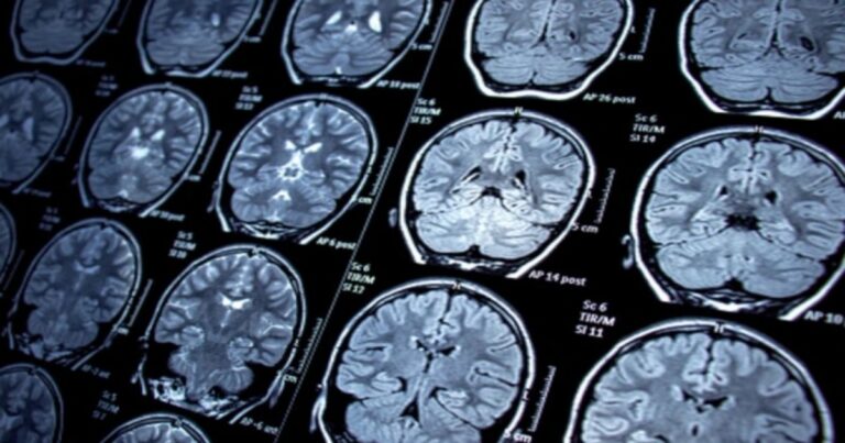 Foi por este motivo que um jovem descobriu que tinha um tumor cerebral