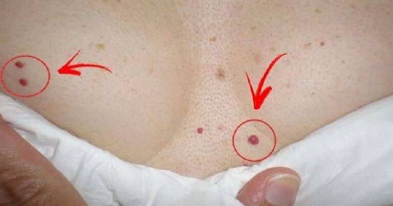 Fique alerta se surgirem bolinhas vermelhas em seu corpo; saiba o porque