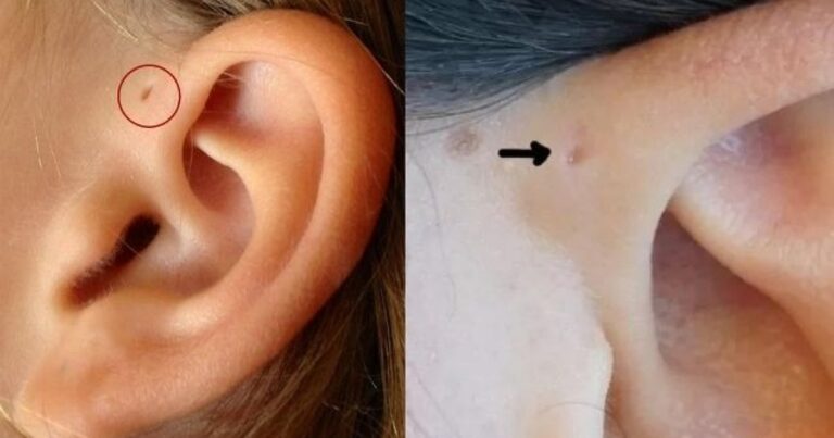 Você sabe o que significa esse furinho que algumas pessoas tem na orelha?
