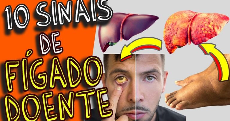 10 sinais de fígado doente que podem ser revelados através de seus pés e você não sabia
