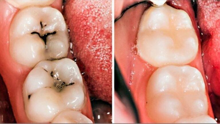 8 maneiras simples de reverter naturalmente as cáries e curar a deterioração dos dentes