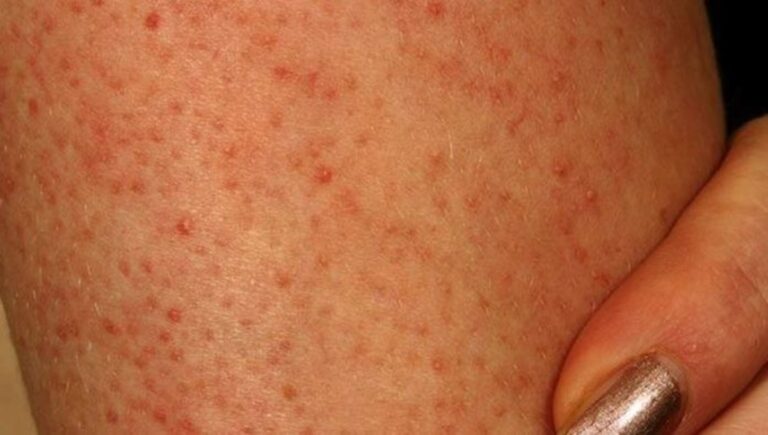 Já notou essas manchas vermelhas na sua pele? Saiba porque elas existem