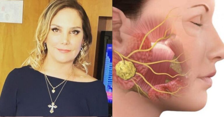 Câncer nas glândulas salivares: Estes são os sintomas do tumor raro que acometeu a atriz Heloísa Périssé