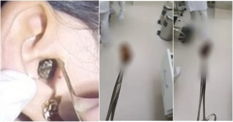 VÍDEO: O que os MÉDICOS acharam no OUVIDO dessa mulher, vai te deixar SURPRESO
