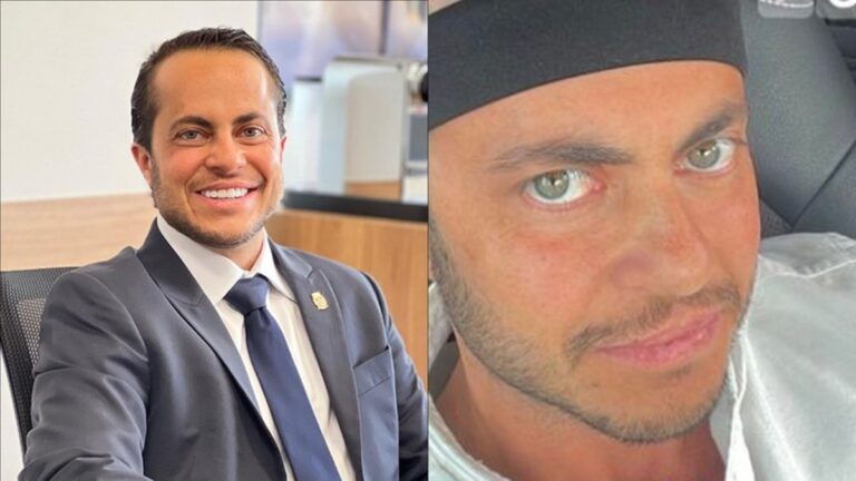 Thammy Miranda exibe resultado do transplante capilar: “Achei que ficaria feio”