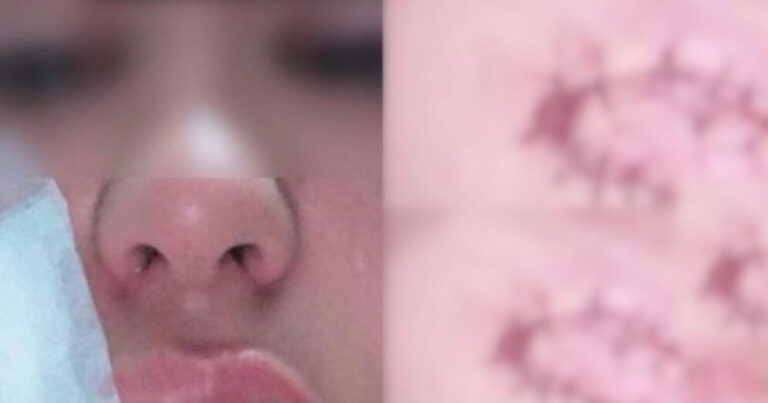 Turista é mordida e tem parte do rosto arrancada por assaltante em praia de Maceió (AL)