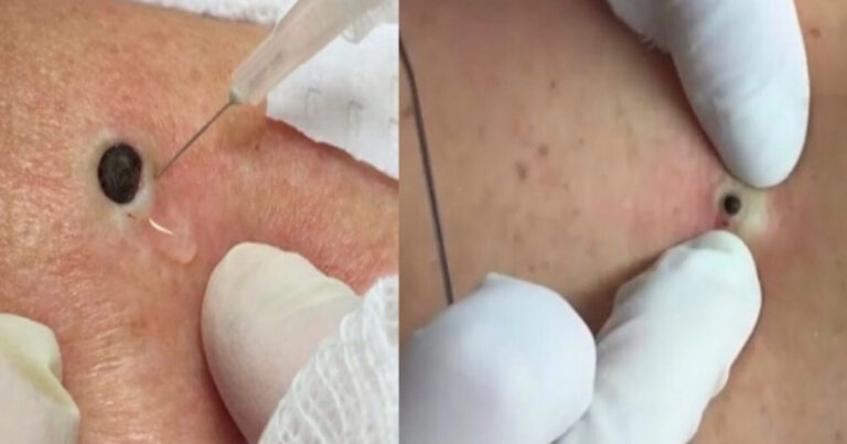 Vídeo de cravo preto sendo removido: você não vai acreditar no que saiu de dentro