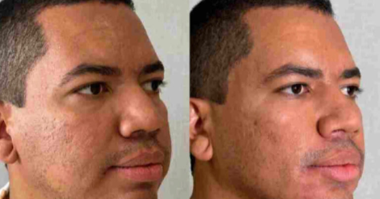 Bruno Gaga se manifesta após críticas por harmonização facial