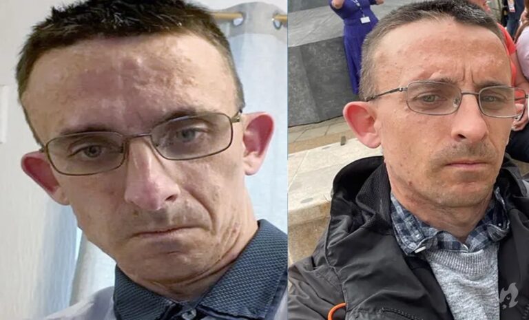Homem cresce 50 cm de altura após retirada de tumor no cérebro