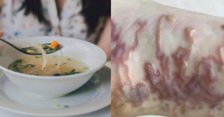 Após consumir sopa, mulher de 58 anos é internada com infestação de parasitas