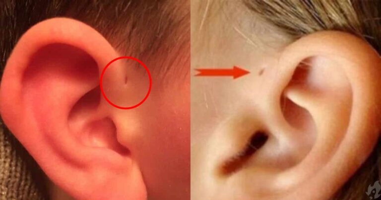Por que algumas pessoas têm ‘furinhos’ na parte superior da orelha?