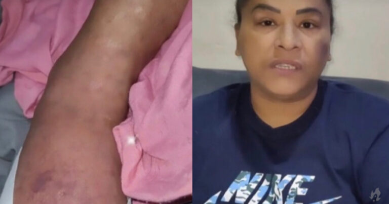 Dependendo do SUS, funkeira desabafa sobre amputação do pé: ‘está necrosado’