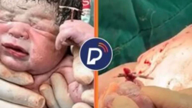 Bebê nasce segurando DIU na mão e médica reage: “Segurando meu troféu de vitória”