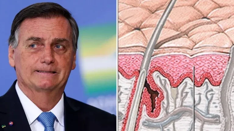 Médico quebra protocolo e entrega detalhes sobre câncer de Bolsonaro: ‘É um dos mais’