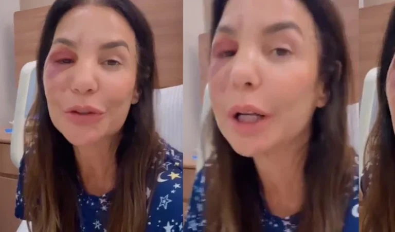 O que aconteceu com Ivete Sangalo? Cantora quebra dois ossos do rosto após desmaio, passa por cirurgia e surge inchada nas redes: Estou bem