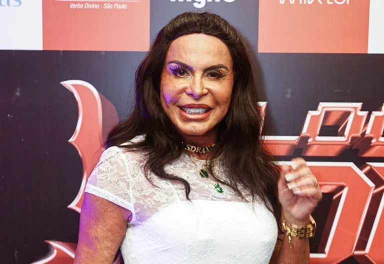 Gretchen fala sobre alopecia progressiva: “Mexe muito com minha autoestima”
