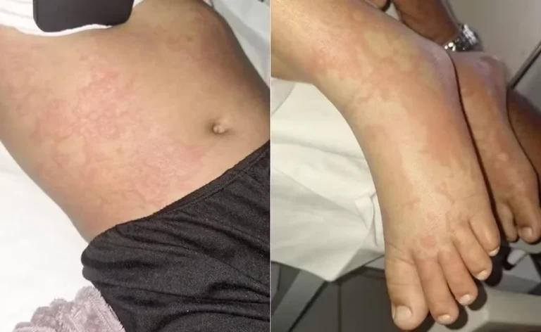Menina de 10 anos luta contra infecção após contato com detergente Ypê