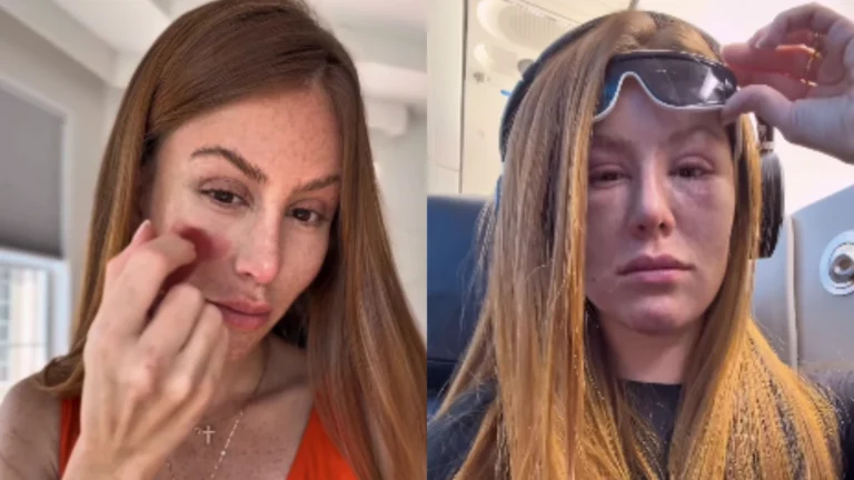 Mari Maria usa laser para tratar tumores nos olhos; veja antes e depois