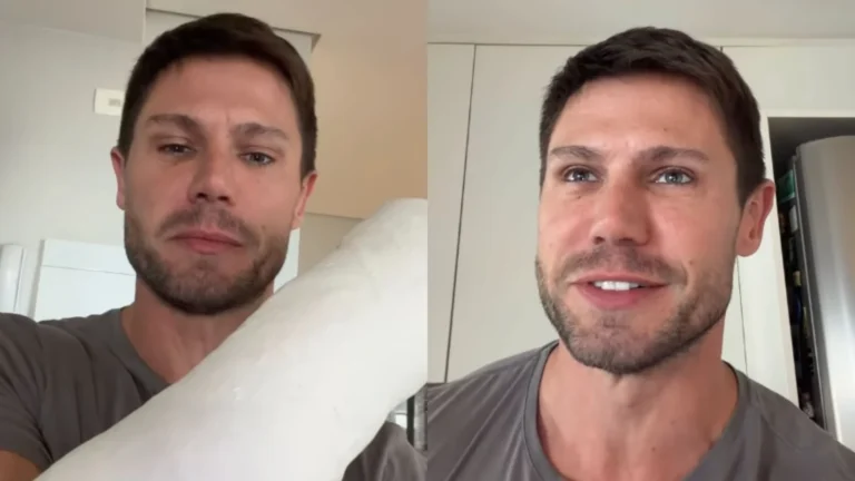 Ex-BBB Jonas Sulzbach relata dificuldades após fraturar o braço